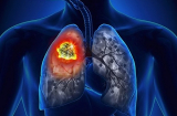Biểu hiện ung thư phổi giai đoạn đầu nhiều người mắc mà chủ quan không biết