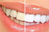 Cao răng bật ra từng mảng dù dày tới đâu ngay lập tức cho răng sáng bóng chỉ với 1 ngàn