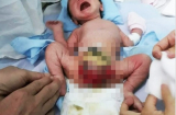 Hi hữu: Cháu bé ở Bình Định bị lộ bàng quang, dị dạng bộ phận sinh dục ngay từ lúc lọt lòng mẹ