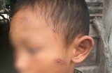 Quảng Ngãi: Bé trai 5 tuổi bị dì ruột đánh bầm tím, rỉ máu khắp người