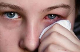 Bệnh đau mắt đỏ mùa hè: Những điều cần phải biết