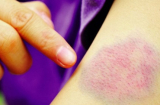 Vết bầm trên da, dấu hiệu cảnh báo bệnh cực nguy hiểm bạn không nên bỏ qua
