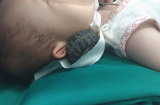 Bé gái 11 tháng tuổi may mắn thoát ch.ết sau khi bị trục sắt đâm sâu vào đầu