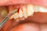 Dấu hiệu ở răng cảnh báo bạn đã mắc ung thư hãy khám ngay kẻo cứu không kịp