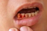 Giáo viên dạy tiếng Anh suýt mất mạng vì chảy máu chân răng mà chủ quan không đi khám