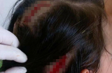 Kinh hoàng bé gái 6 tuổi bị chó cắn, phải khâu hơn 30 mũi