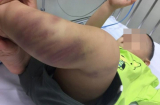 Vụ bé trai 1 tuổi bị bạo hành nghiêm trọng: Lộ diện người phụ nữ “bí ẩn” bỏ lại bé trai tại bệnh viện