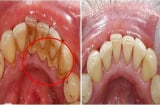 Cao răng bật ra từng mảng, hôi miệng kinh niên cũng khỏi ngay lập tức khi ngậm thứ này trước khi đi ngủ