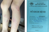 Hà Nội: Học sinh lớp 2 bị cô giáo đánh tím hai chân đến khi gãy thước vì ra chơi vào lớp muộn