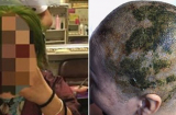 Nhuộm tóc 4 lần trong 7 tiếng để có màu xanh lá, người phụ nữ bị sốc phản vệ và phải cạo trọc đầu