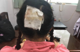 Nữ bác sĩ bị bỏng sâu, tróc gần như toàn bộ da đầu sau khi uốn tóc setting