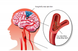 5 bài thuốc dân gian cực tốt cho người bị thiếu máu não