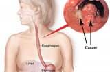 Người phụ nữ qua đời vì ung thư thực quản khi 30 tuổi, bác sĩ cảnh báo thói quen xấu nhiều người mắc phải