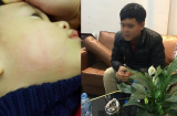 Bé trai 22 tháng tuổi bị bác sĩ tát sưng tấy mặt vì sặc, bắn nước vào mặt khi đang khám