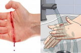 Cách xử lý nhanh khi bị đứt tay, chảy máu