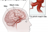 Bệnh phình động mạch não là gì?