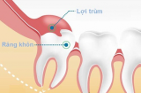 Tại sao cần phải nhổ răng khôn?