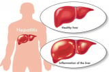 Hướng dẫn cách phòng ngừa bệnh viêm gan cấp