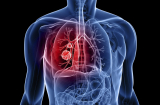 Ung thư phổi là gì - là điều ai ai cũng cần biết để phòng tránh ngay