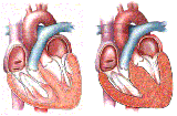 Dấu hiệu nhận biết bệnh tim do thiếu máu cục bộ