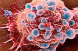 Trong cơ thể ai cũng có tế bào ung thư và đây là 3 nguyên tắc chặn đứng sự hình thành của khối u
