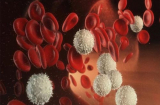 Bệnh ung thư máu ác tính có nguy hiểm không?