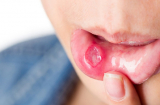 Bị nhiệt miệng có ảnh hưởng đến thai nhi không?