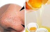 Cách loại bỏ mụn đầu đen vùng mũi nhanh và hiệu quả