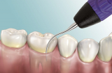 8 mẹo làm các vết ố vàng trên răng biến mất hiệu quả nhất