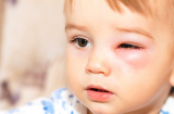 Bệnh đau mắt ở trẻ em và cách cha mẹ cần biết để phòng tránh