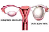 Làm thế nào để biết bạn bị buồng trứng đa nang, lạc nội mạc tử cung?