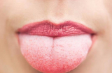 Nếu có 7 dấu hiệu thay đổi này ở lưỡi, hãy cẩn thận vì có thể sức khỏe của bạn đang gặp vấn đề