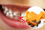 7 thực phẩm gây hại cho răng bạn nhất định phải tránh xa nếu không muốn mình bị 'kém duyên'