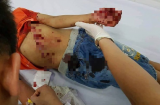 Bé trai 8 tuổi nhập viện cấp cứu vì pin đồ chơi bất ngờ phát nổ