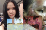 Cô gái người Anh nhiễm vi khuẩn ăn thịt người, đáng chú ý căn bệnh ghê gợn này từng xuất hiện ở Việt Nam
