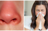 Nếu mũi xuất hiện 4 dấu hiệu lạ này chứng tỏ sức khỏe của bạn đang có vấn đề, đừng chủ quan