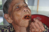 Cụ bà gần 100 tuổi bất ngờ.... mọc răng