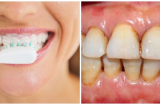 Sai lầm cực phổ biến khi vệ sinh khiến hàm răng bị ố vàng, hơi thở có mùi và rụng rất sớm