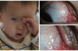 Bé trai 2 tuổi xuất hiện giun sán đang bò lúc nhúc trong mắt nguyên nhân là do bố mẹ quá 'lười'