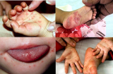 Dịch tay chân miệng: Lại thêm trẻ tử vong - cha mẹ cần làm điều này ngay khi con bệnh để cứu bé