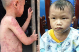'Cậu bé người cóc” 5 năm sống trong diện mạo sần sùi như cóc hiện giờ ra sao?