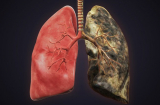 Người có thói quen này dễ mắc ung thư phổi gấp 30 lần, tránh ngay kẻo gặp 'tử thần' sớm