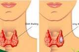 Thấy có dấu hiệu này ở vùng xung quanh vùng cổ họng, hãy cẩn thận với căn bệnh ung thư tuyến giáp