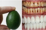 5 mẹo đánh bay cao răng chỉ sau 3 phút, giúp bạn lấy lại được hàm răng trắng sáng