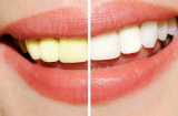 Tuyệt chiêu giúp bạn có hàm răng trắng sáng nhanh chóng