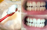 Làm răng sứ chi cho tốn kém, muốn răng trắng sáng tự nhiên hãy áp dụng bí quyết này