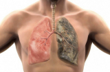 Trả lời CÓ với 6 câu hỏi này: Hãy đến gặp bác sĩ gấp vì tế bào ung thư đang lớn dần trong phổi