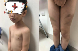 Bé trai 7 tuổi bị bố bạo hành dã man, bầm tím khắp cơ thể khiến dư luận phẫn nộ