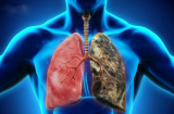 6 việc giúp 'giải phóng' phổi khỏi bệnh tật, ung thư, người còn khoẻ phải làm ngay kẻo mang hoạ