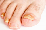 10 dấu hiệu trên bàn chân tưởng chừng 'vô hại' nhưng lại cảnh báo vấn đề nghiêm trọng về sức khỏe, cần khám ngay